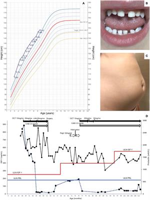 Case report: Management of pediatric gigantism caused by the TADopathy, X-linked acrogigantism